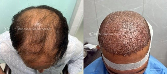 Effective Treatments for Male Baldness