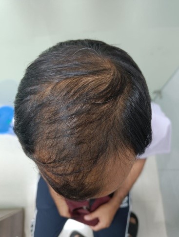 You are currently viewing Understanding Male Baldness: Causes, Treatments, and Expert Advice