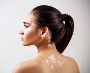 Read more about the article Embracing Uniqueness: Understanding Vitiligo and Its Treatment Options