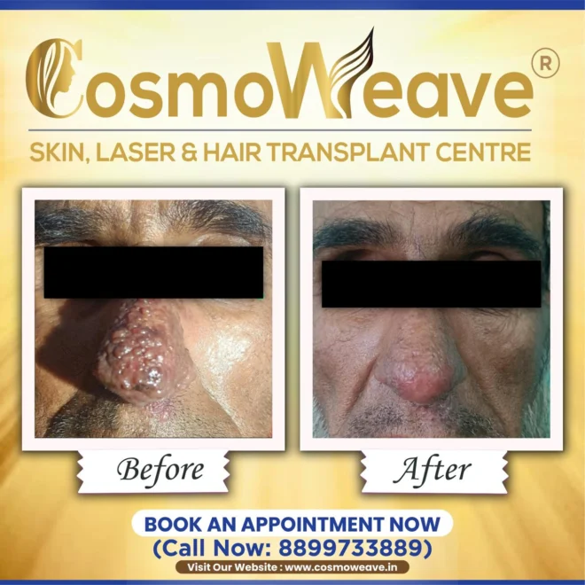 Treatment result before and after treatment result at Cosmoweave Jammu