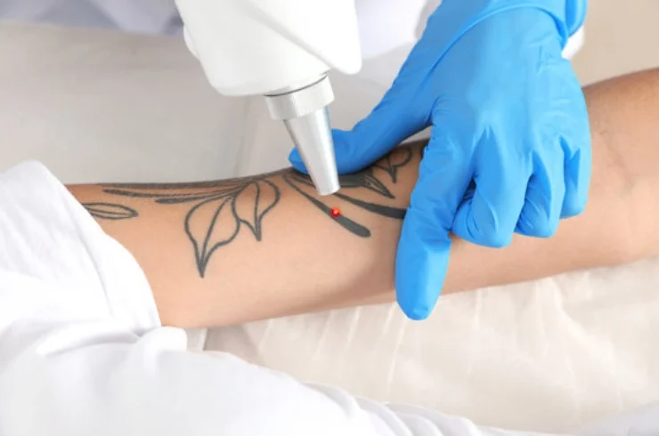 Pico Laser for Tattoo Pigmentation 16