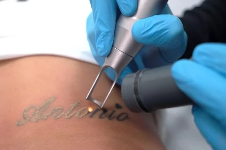 Tattoo Removal 16