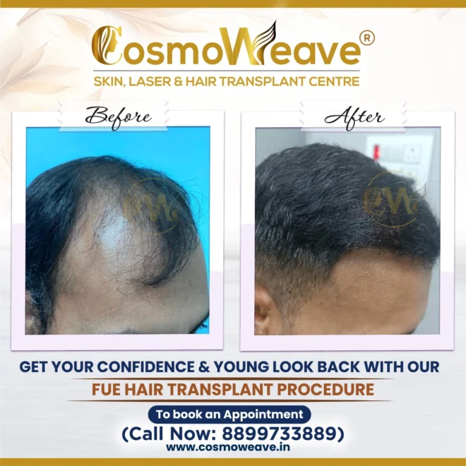 Hair transplant before and after treatment result at Cosmoweave Jammu