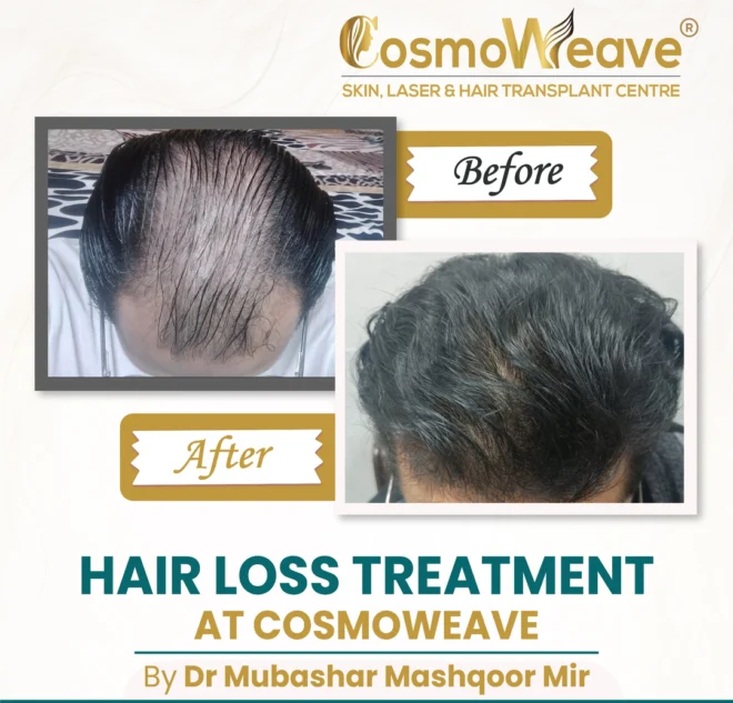 Hair restoration before and after treatment result at Cosmoweave Jammu