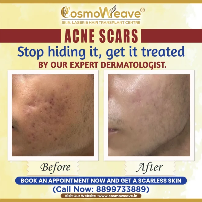 Acne & scars before and after treatment result at Cosmoweave Jammu