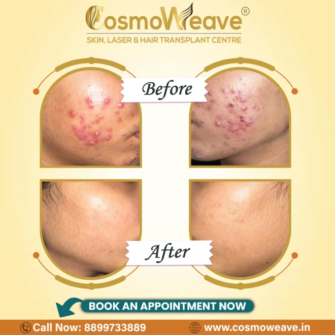 Skin treatment before and after treatment result at Cosmoweave Jammu