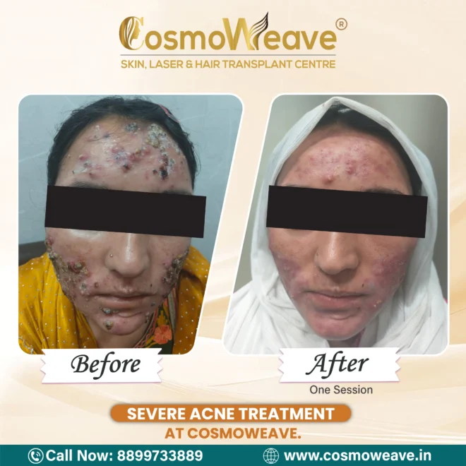 Hair transplant before and after treatment result at Cosmoweave Jammu