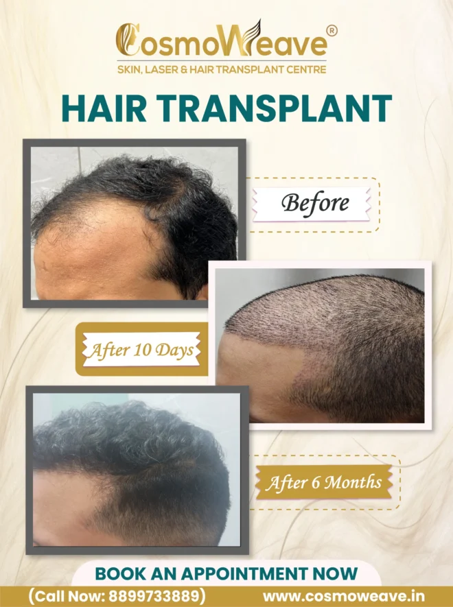 Hair transplant before and after treatment result at Cosmoweave Jammu
