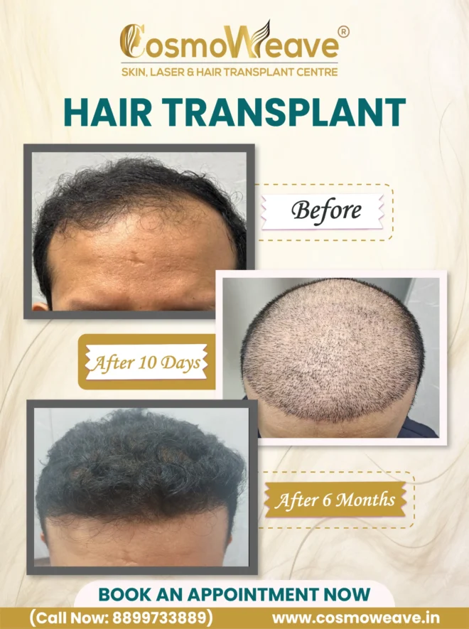 Hair transplant before and after treatment result at Cosmoweave Jammu