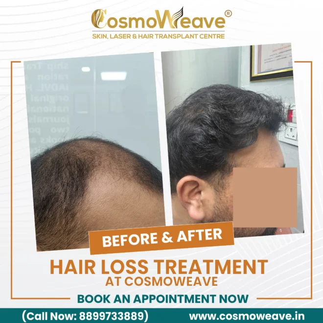 Hair transplant before and after treatment result at Cosmoweave Jammu