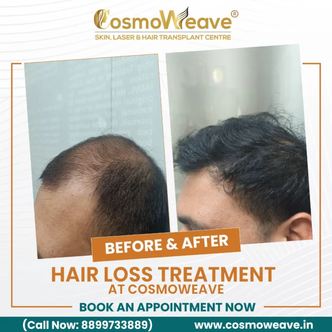 Hair-loss treatment photographs showing visible scalp on the left and fuller-looking coverage on the right.