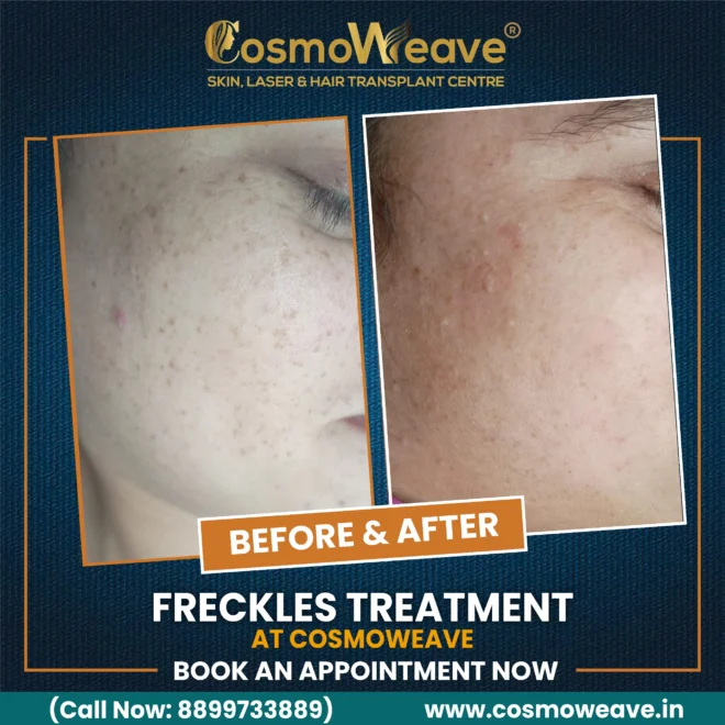 Hair transplant before and after treatment result at Cosmoweave Jammu